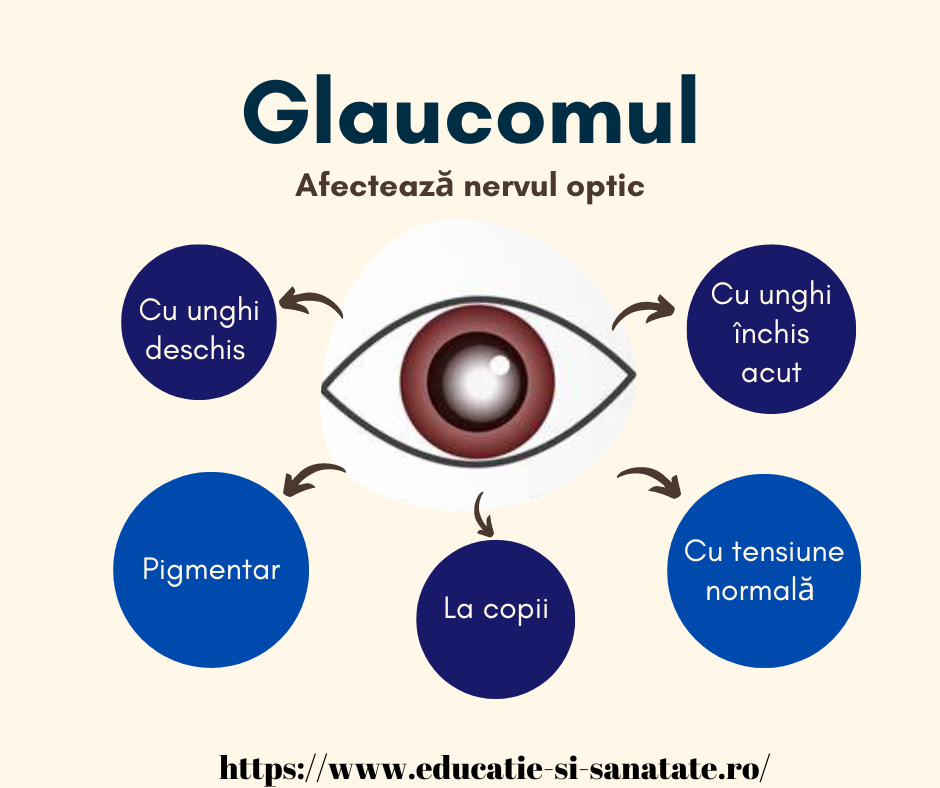 Glaucomul